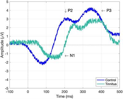 Comparative analysis of acoustic therapies for tinnitus treatment based on auditory event-related potentials